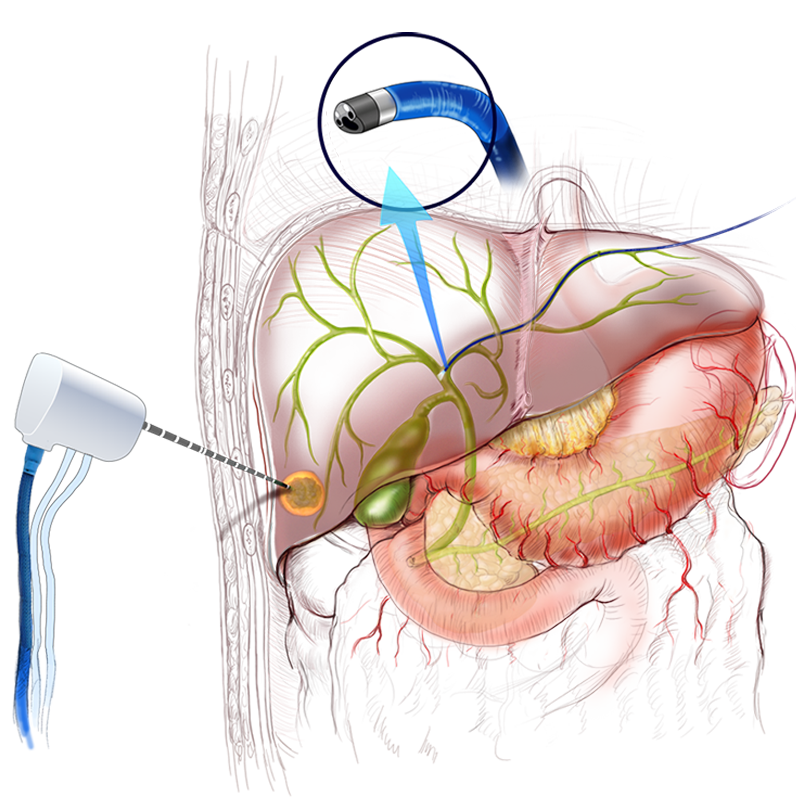 IrcadFrance's tweet photo. 🌟 New monthly focus: “#Surgery of the 3rd millennium”! 🚀
🎥 https://t.co/EcEwD6zODU
Don't miss out on this exclusive showcase of #percutaneoussurgery, #minimallyinvasivesurgery, brought to you by #websurg and #ircad. https://t.co/luoRpjnQVe