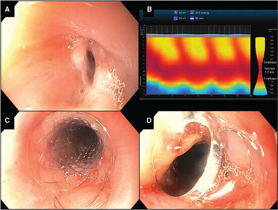 JPGNonline's tweet image. 3yo girl with post-neuroblastoma esophageal stricture. EndoFLIP shows 5.5mm, 2cm stricture. Next step in management?

Answer and learn more 👉 onlinelibrary.wiley.com/journal/153648…

#imageofthemonth #quickpoll