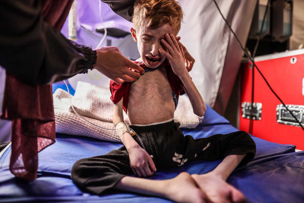 Fadi Zant, aged 9, experiencing malnutrition, receives treatment after evacuated from the northern Gaza Strip to the IMC field hospital in Rafah. The Gaza Strip is on the brink of famine as Israeli attacks on the area enters its sixth month. (Photo by Ali Jadallah/Anadolu)