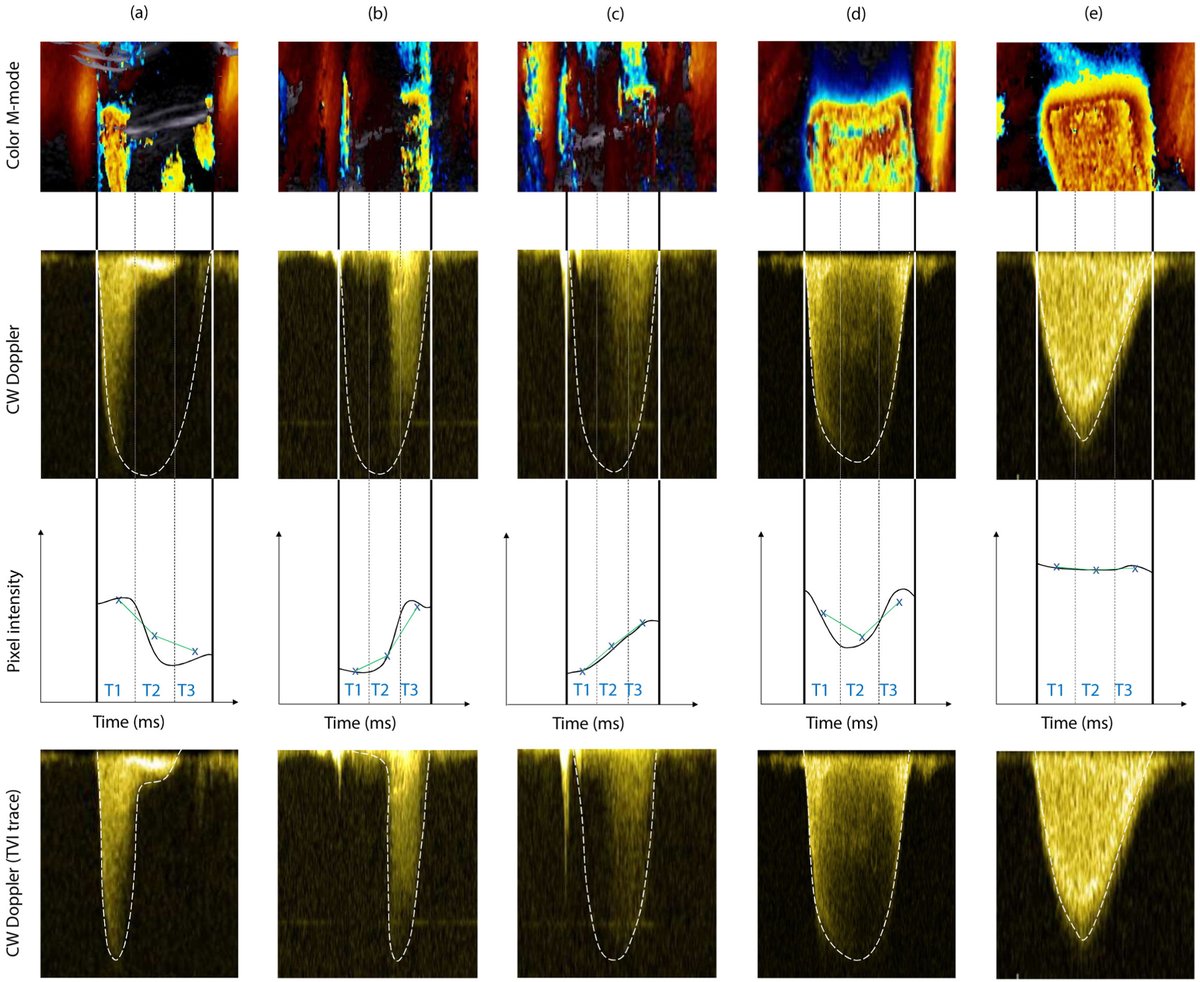 In mitral regurgitation, temporal variation of MR flow has been considered an important reason for inaccurate MR grading. We investigated whether assessing MR flow variation using a dimensionless index with echo is feasible and clinically meaningful. bit.ly/3Pz0lti