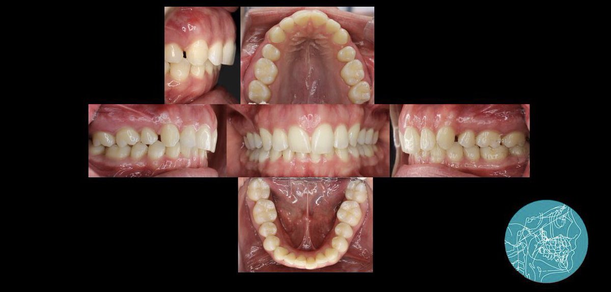 Las fotografías intraorales y extraorales son un elemento fundamental para la elaboración de un diagnóstico adecuado en ortodoncia. #orthodontics <a href="/InExcelsisUS/">In Excelsis</a>