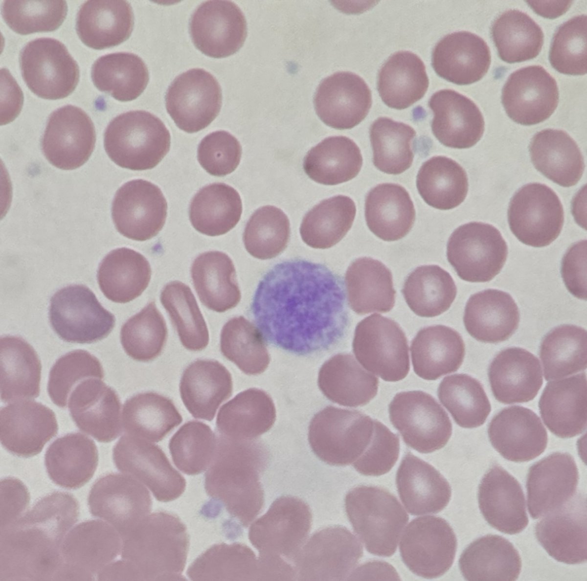 Haven't posted in a while, so here is the giant platelet of the day! I hope everyone is learning and strengthening the pathology community in Baltimore this week. ##pathtwitter