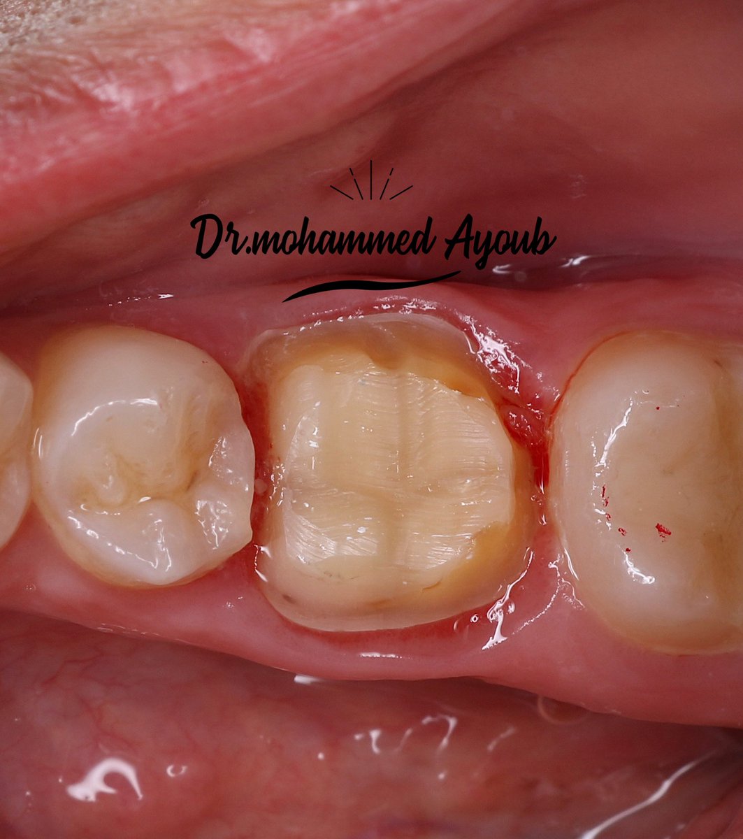 i_edx's tweet photo. Retreatment of RCT for #36 previously treated with symptomatic apical periodontitis; we can see the healing progression of periapical area and resolution of the cyst following the retreatment after 4 months..
composite restoration&amp;tooth preparation and finally Zirconia crown 🦷👑 https://t.co/HRmN7aWBOg
