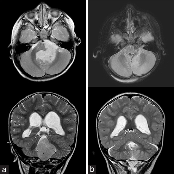 The 2024 @posteriorfossa global meeting provides a necessary step towards greater alignment on the characterization of #posteriorfossasyndrome amongst #braintumor providers, which would help further #PFS research and clinical care. Register today: stjude.org/pbii-symposium