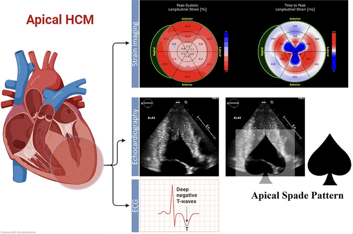 “Inverse-amyloid” or “blueberry-on-top” strain pattern is a finding in Apical HCM •The time to peak strain parametric map is the best depiction of this unique pattern • Pattern is supportive for dx of apical HCM @VLSorrellImages @CASEfromASE More → bit.ly/3TC7QAC