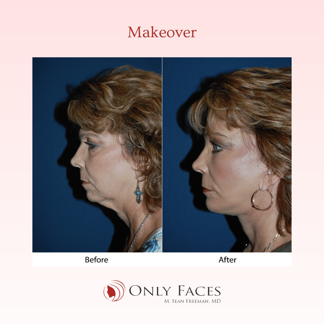 OnlyFacesCLT's tweet photo. This 53-year-old is two months post-op from a Segmental Endoscopic #BrowLift:  3/4-R/L, Deep Plane #Facelift,  Lower lid: SOOF lift #blepharoplasty, #ChinImplant, and Ablative CO2 Laser Resurfacing of eyes and mouth. #OnlyFaces https://t.co/HfIfr8cU3K