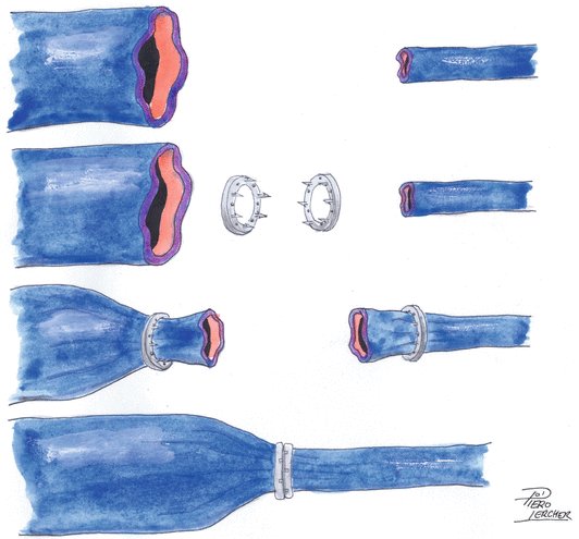 SaadIMallah's tweet photo. A reconstructive plastic surgeon at a microsurgery conference said that vascular anastomosis couplers for veins (takes minutes, available to non-experts) will soon become widespread for arterial applications...#vascular surgeons, what do you have to say to that? 👀 https://t.co/FbnsBba4lY