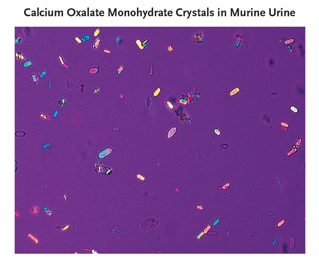 This letter describes a woman with recurrent episodes of acute kidney injury due to oxalate nephropathy after hair-straightening procedures and provides evidence that glyoxylic acid is responsible. Read the full correspondence: nej.md/4agImPW