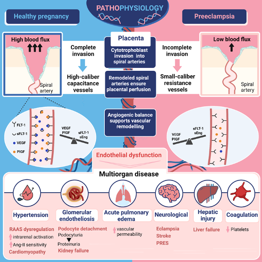 T0e: Pathophysiology of pre-eclampsia ⚖️Central event is imbalance between angiogenic and antiangiogenic factors #NephJC 👇The overview of pre-eclampsia pathogenesis from @ASNKidney360 ✍️By @divyaa24 @silvishah @NephroSeeker @DrSandiDumanski 🔗journals.lww.com/kidney360/full…
