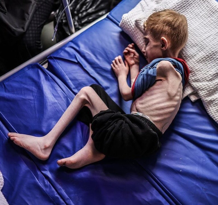 Fadi Zant, 9, suffering from malnutrition, is treated after being evacuated from northern Gaza to the IMC field hospital in Rafah. The Gaza Strip faces famine as Israeli attacks continue into the sixth month. - @alijadallah66