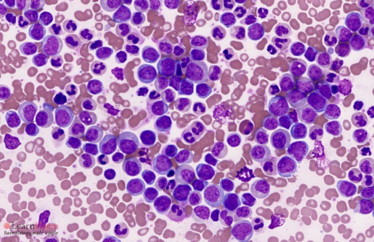 Don't judge a book by its cover,appearances can be deceiving!!!

A 65yr ♂️ with recurrent infection,bleeding,weight loss,fatigue and splenomegaly.CBC done showed hyperleukocytosis,anaemia,thrombocytopenia.
PBF done shows 👇.On admission he complained of severe headache,later