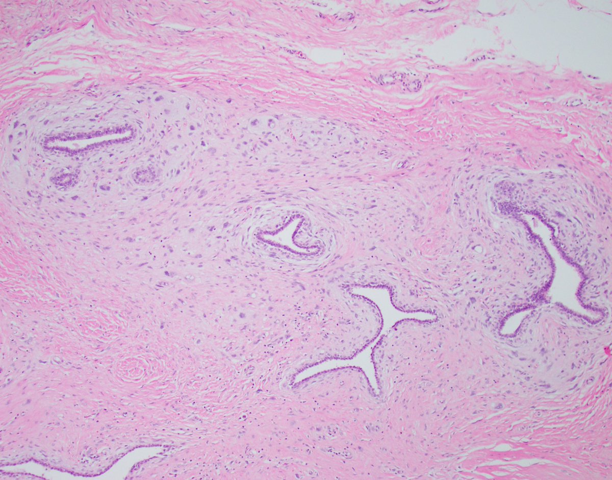 Beautiful example of periductal stromal condensation in a phyllodes tumor #breastpath #PathTwitter @wusm_pathology @washupathedu