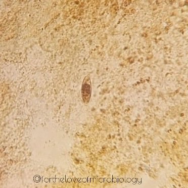 Immature oocyst of Cystoisospora belli (aka Isospora belli) in an iodine wet mount showing a single sporoblast.

#Fortheloveofmicrobiology #clinicalmicrobiology
 #mmidsp #microrounds #IDpath #ASMClinMicro #MicroTwitter #WomeninMicrobiology #STEM #medtwitter #ClinMicro #pathbugs