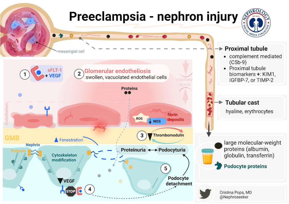 NephJC's tweet photo. T0i: #NephJC
Glomerular endotheliosis= pathognomonic for PE
⚔️ Flt-1 inhibits VEGF
🔴Glom endotheliosis- swollen, vacuolated endothelial cells, swollen mesangial cells, subendothelial prot deposits+ tubular casts
Infographic by @Nephroseeker #Kireports
https://t.co/O0pNWQ7sSn https://t.co/ZJKjSM1OvP