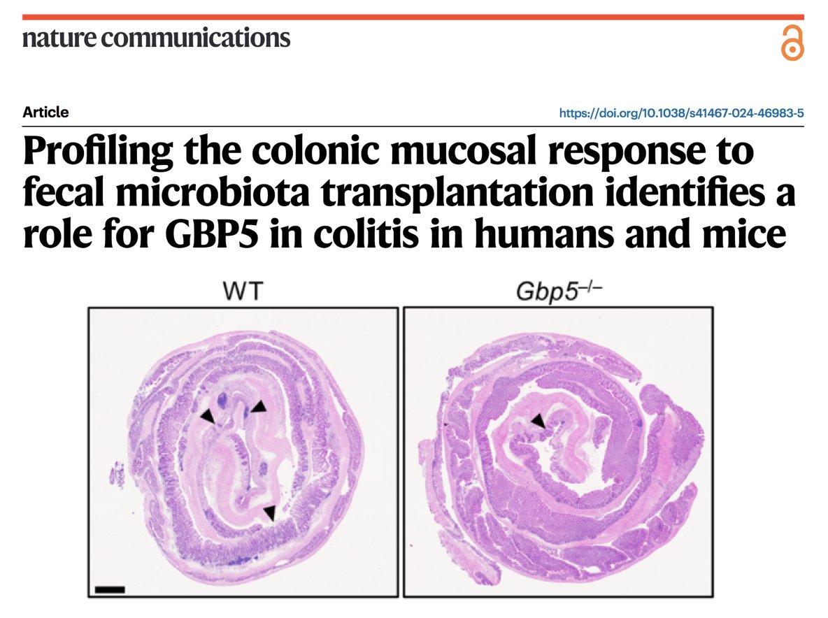 Si Ming Man (@simingman1) on Twitter photo 🔥Faecal microbiota transplantation (FMT) is a way to treat ulcerative colitis. Our collaborative work with <a href="/NOKaakoush/">Nadeem Kaakoush</a> shows that in patients undergoing this treatment, the immune protein GBP5 needs to get out of the way to resolve bowel inflammation 🔥#badinflammation #ibd 1/2 🔥Faecal microbiota transplantation (FMT) is a way to treat ulcerative colitis. Our collaborative work with <a href="/NOKaakoush/">Nadeem Kaakoush</a> shows that in patients undergoing this treatment, the immune protein GBP5 needs to get out of the way to resolve bowel inflammation 🔥#badinflammation #ibd 1/2