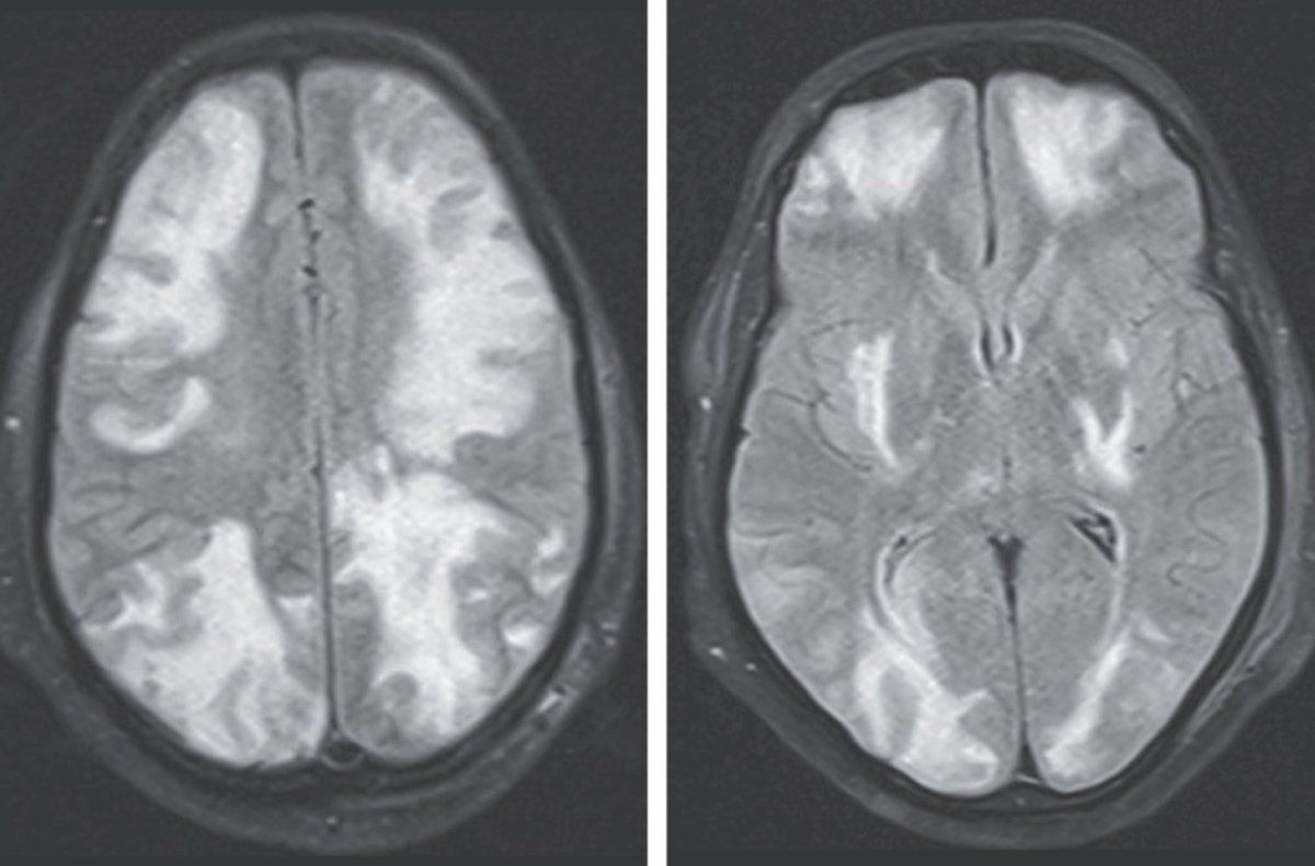 Diagnosis in a patient w altered mental status? (Source: NEJM)