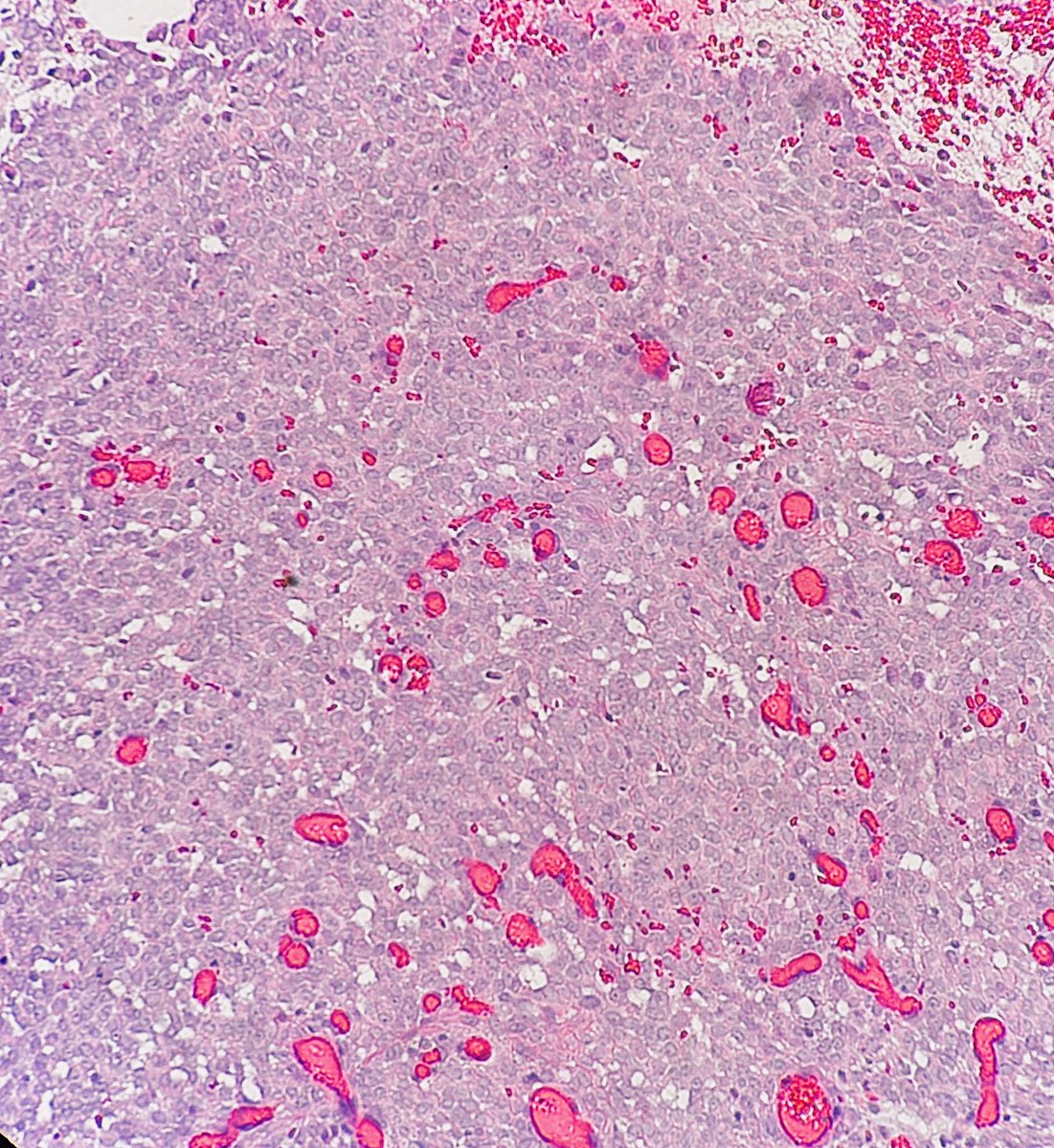 I am characterized by an t(X;18) translocation. 

I can occur in any part of the body and be monophonic or biphasic. 

The cell of origin is still under debate. 

Who am I? 🤔 

#pathagonia #pathx #path4people #surgpathx #surgicalpathology #bstpath #softtissue #hemeonc #orthox