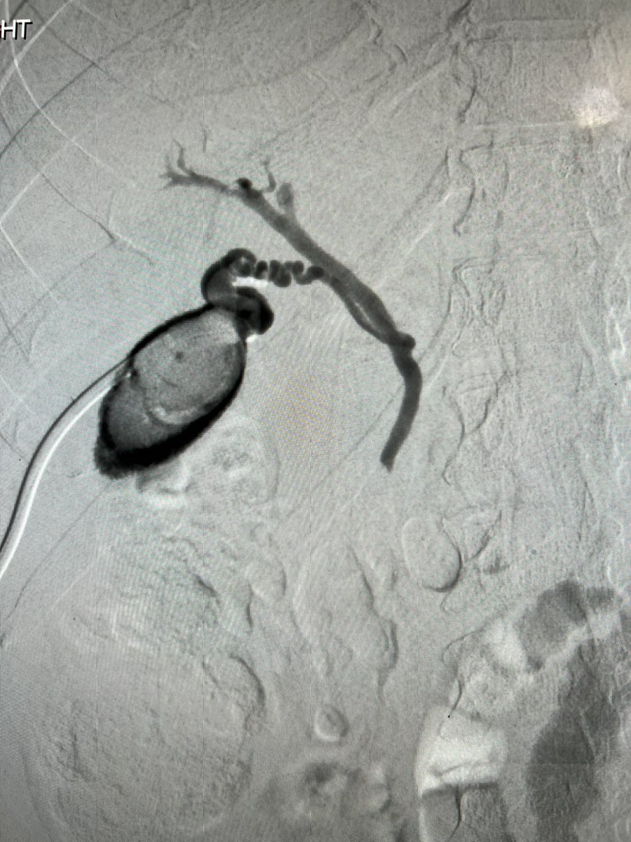 MikeJHsu's tweet photo. Traversing the cystic duct with reduction of multiple wire loops via gallbladder access. Done for Spyglass lithotripsy of choledocholithiasis (prior roux-en-Y). Platform was 0.014 synchro soft, Truselect, 4F glidecath. Curious to hear of any easier ways to cross? #twittIR #irad https://t.co/aLrOXCaMHO