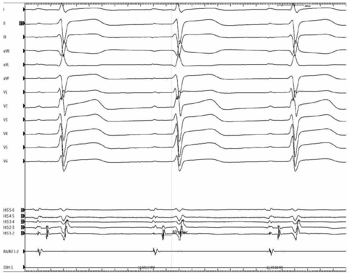 jeffrey_vinocur's tweet photo. #EPeeps #FellowFirst
Mechanism of premature beats?
Fig 1: sinus
Fig 2-3: premature beat
Fig 4: cute bonus tracing https://t.co/nvQWb4APdj