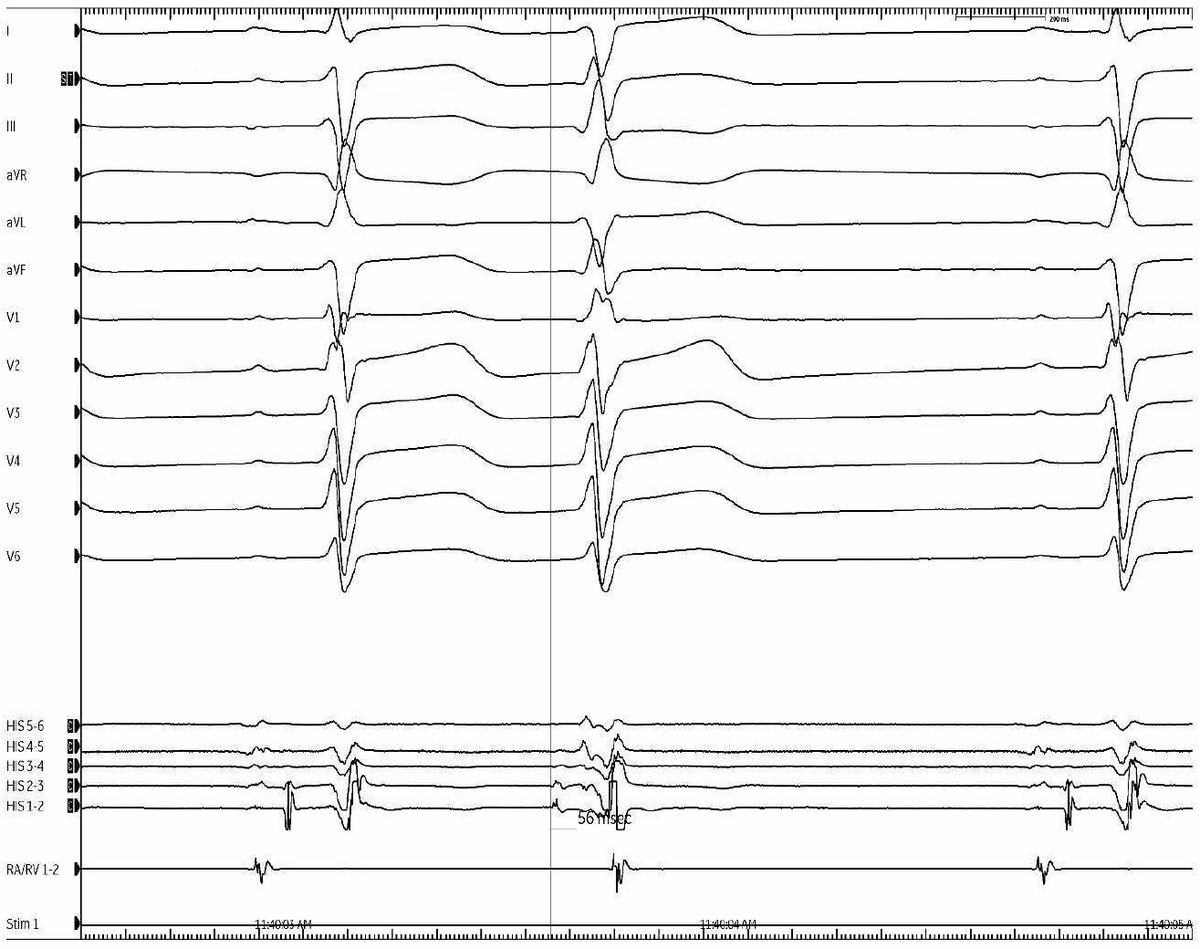 jeffrey_vinocur's tweet photo. #EPeeps #FellowFirst
Mechanism of premature beats?
Fig 1: sinus
Fig 2-3: premature beat
Fig 4: cute bonus tracing https://t.co/nvQWb4APdj