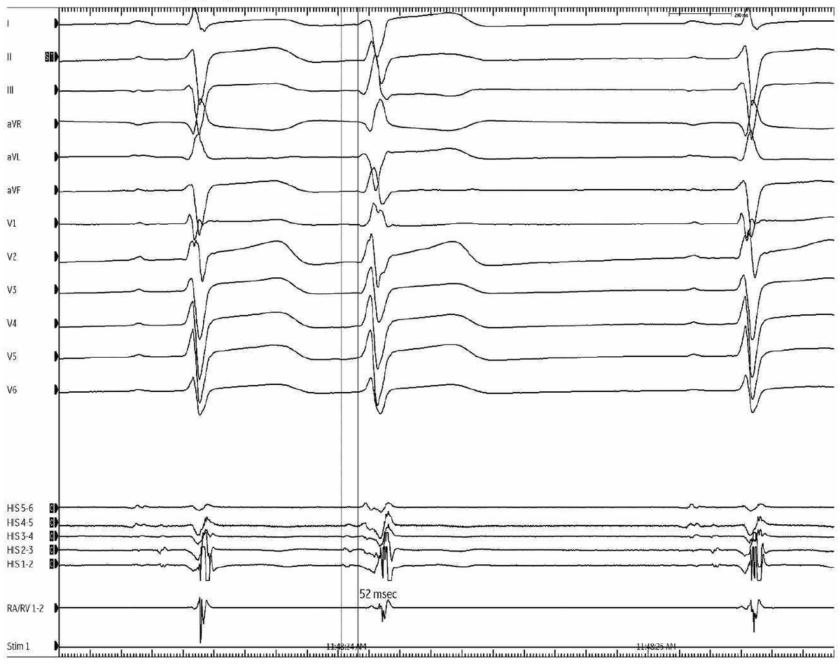 jeffrey_vinocur's tweet photo. #EPeeps #FellowFirst
Mechanism of premature beats?
Fig 1: sinus
Fig 2-3: premature beat
Fig 4: cute bonus tracing https://t.co/nvQWb4APdj