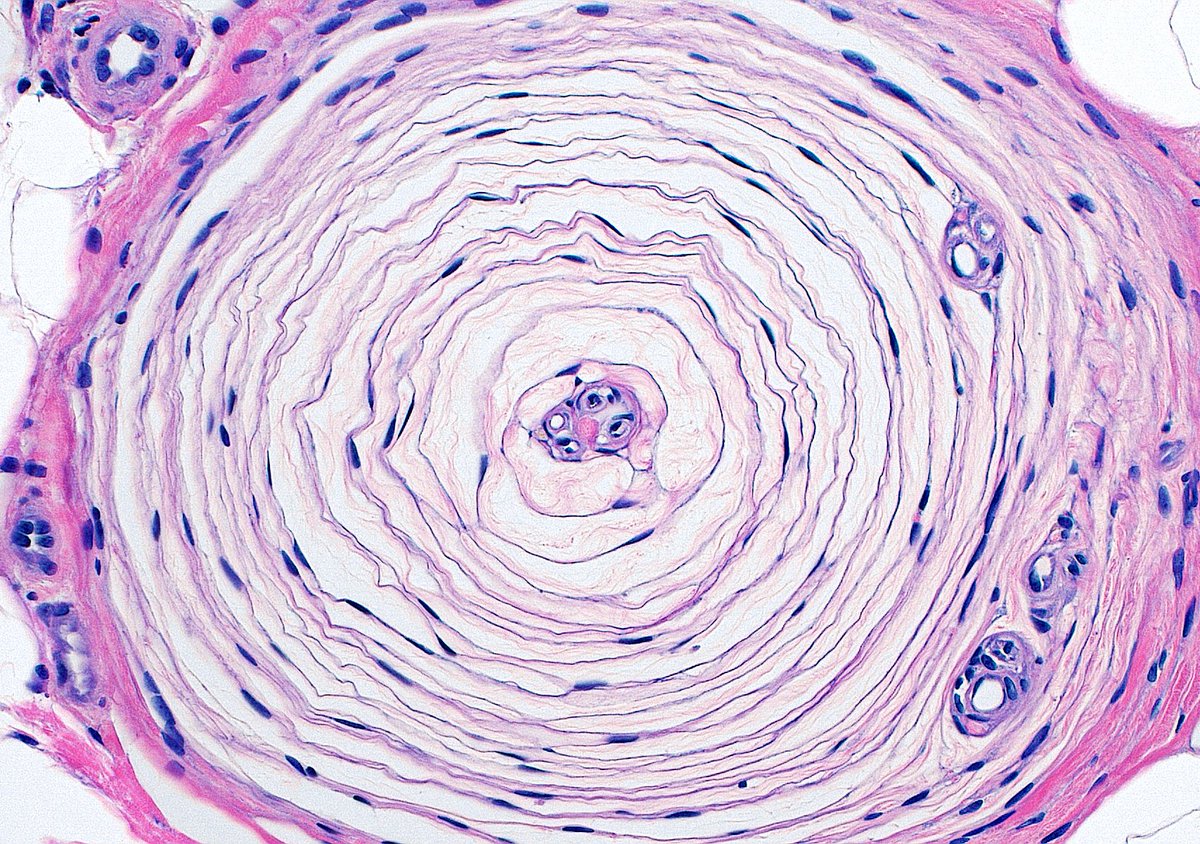 The beautiful #histology of a Pacinian Corpuscle ~ Concentric fibrous lamellae surrounding a central sensory nerve ending (pink dot in the center). You can even see tiny capillaries in the center and between lamellae. #dermpath #neuroanatomy #anatomy #pathology #PathArt