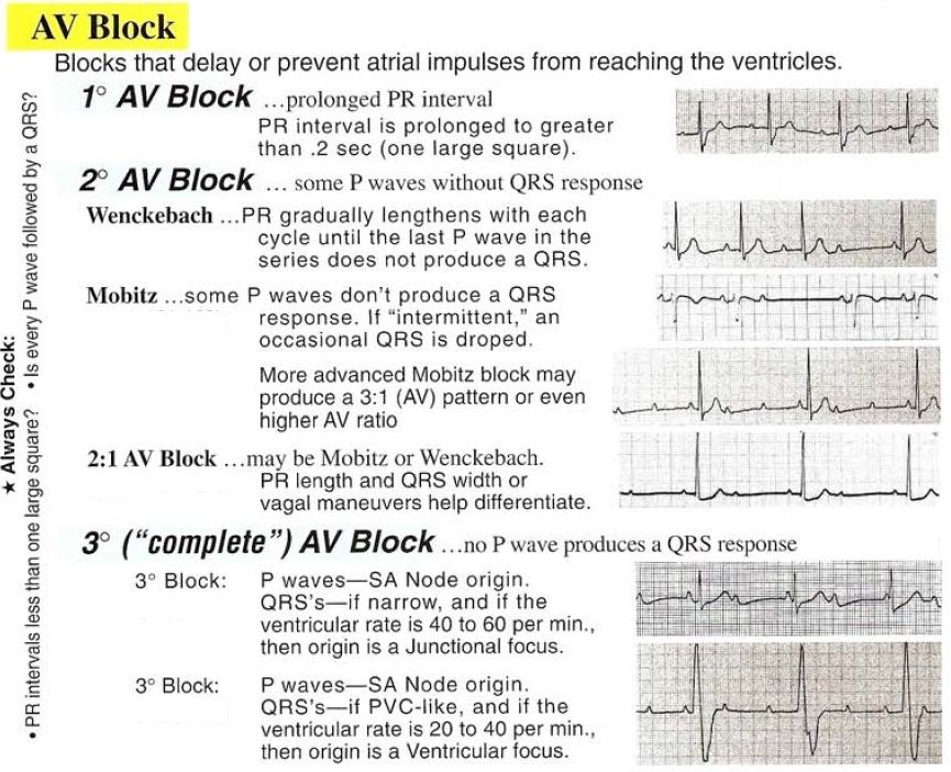 AV Block.