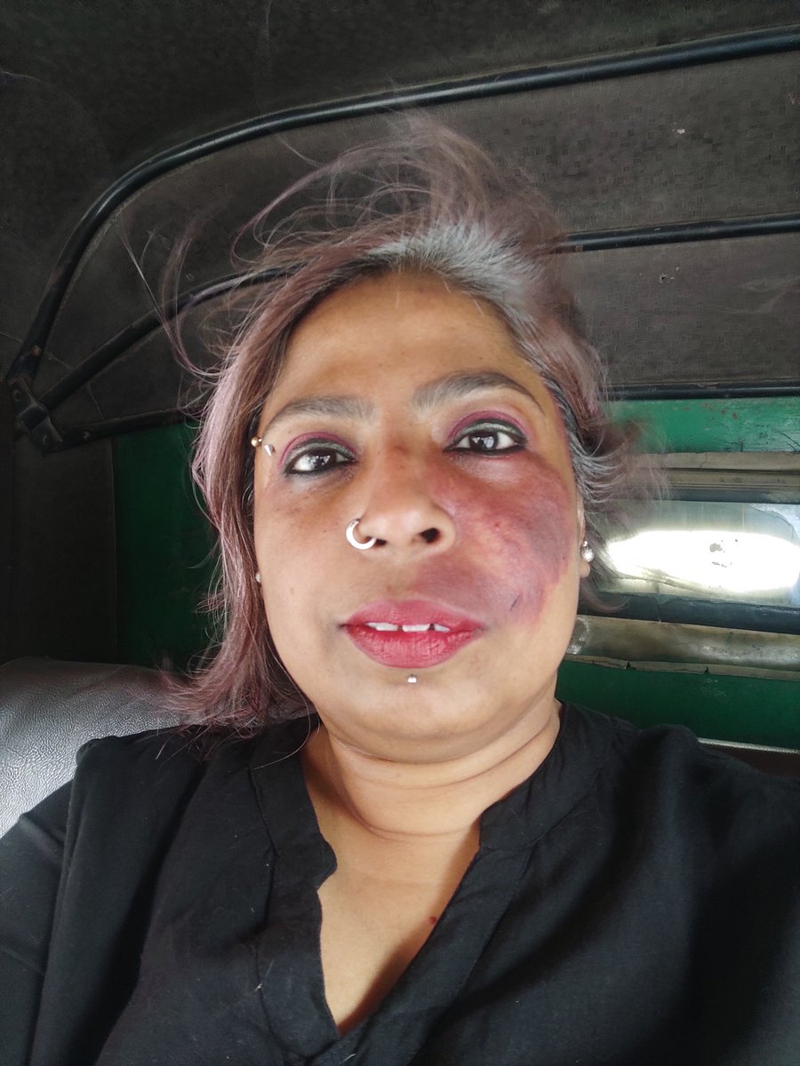 On my way to the next field visit with @FoundationAzad. North Delhi today. Summers are on, no base make-up plus sweat makes the birthmark darker. The cat gave a scratch near the lips while playing with her human mum. Notes from a feminist at work. #Womenatwork #feministjobs