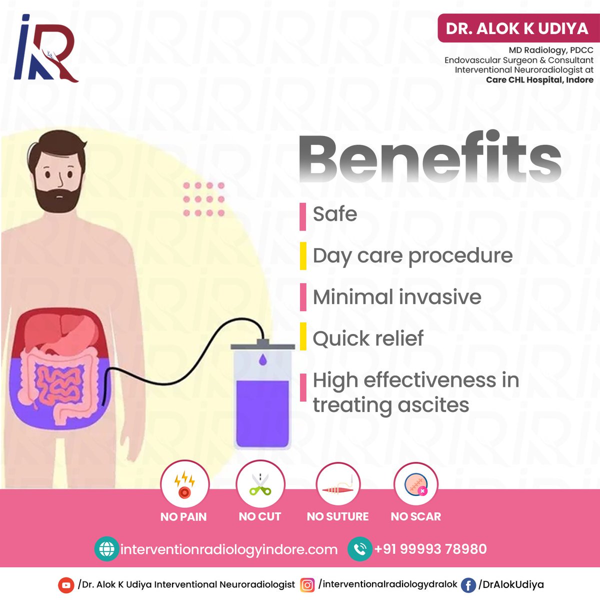 Did you know that Ascites Tap, also known as paracentesis or abdominocentesis, is a procedure used to remove fluid buildup in the abdomen 👨‍⚕️ Schedule an appointment with Dr. Alok K Udiya: +91 99993 78980 Or visit 📍 Care CHL Hospital interventionradiologyindore.com #dralok#dralokkudiya