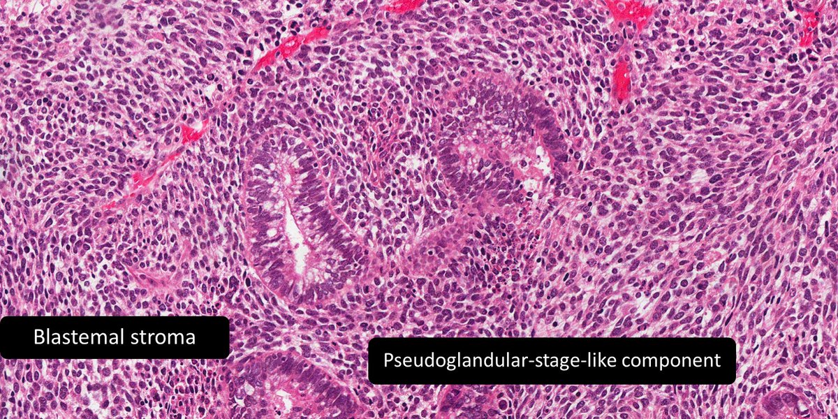 DrCycloPath's tweet photo. Adult lobectomy. Diagnosis?
A) Pleuropulmonary blastoma
B) Pulmonary blastoma
C) Low grade fetal adenocarcinoma
#pulmpath #pathresidents #pathresidents #pedipath 🔬https://t.co/gBxeRR5BjJ https://t.co/OxOurp20N1