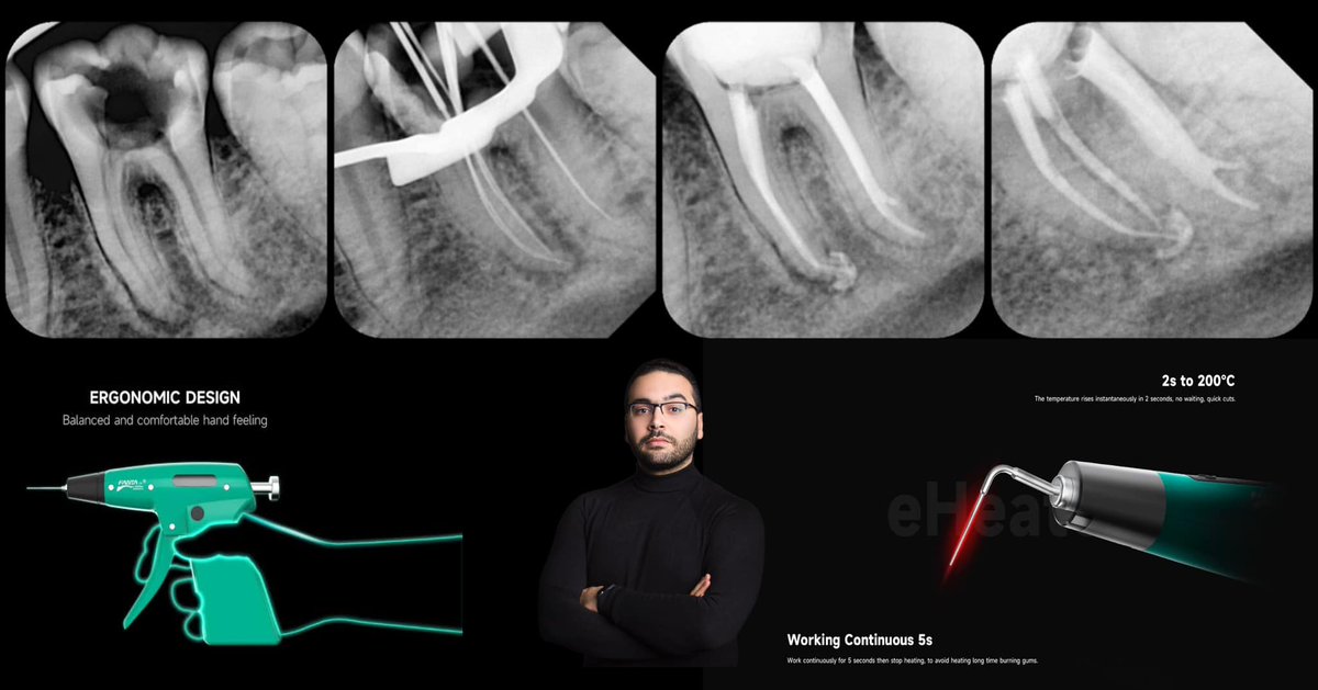 Learn about #ObturationSystemDownPack and #ObturationSystemBackfill❤️
Case courtesy of Dr. Waleed Kurdi Endodontics！
#Fantadental #endodontics #rootcanals #endoequipment