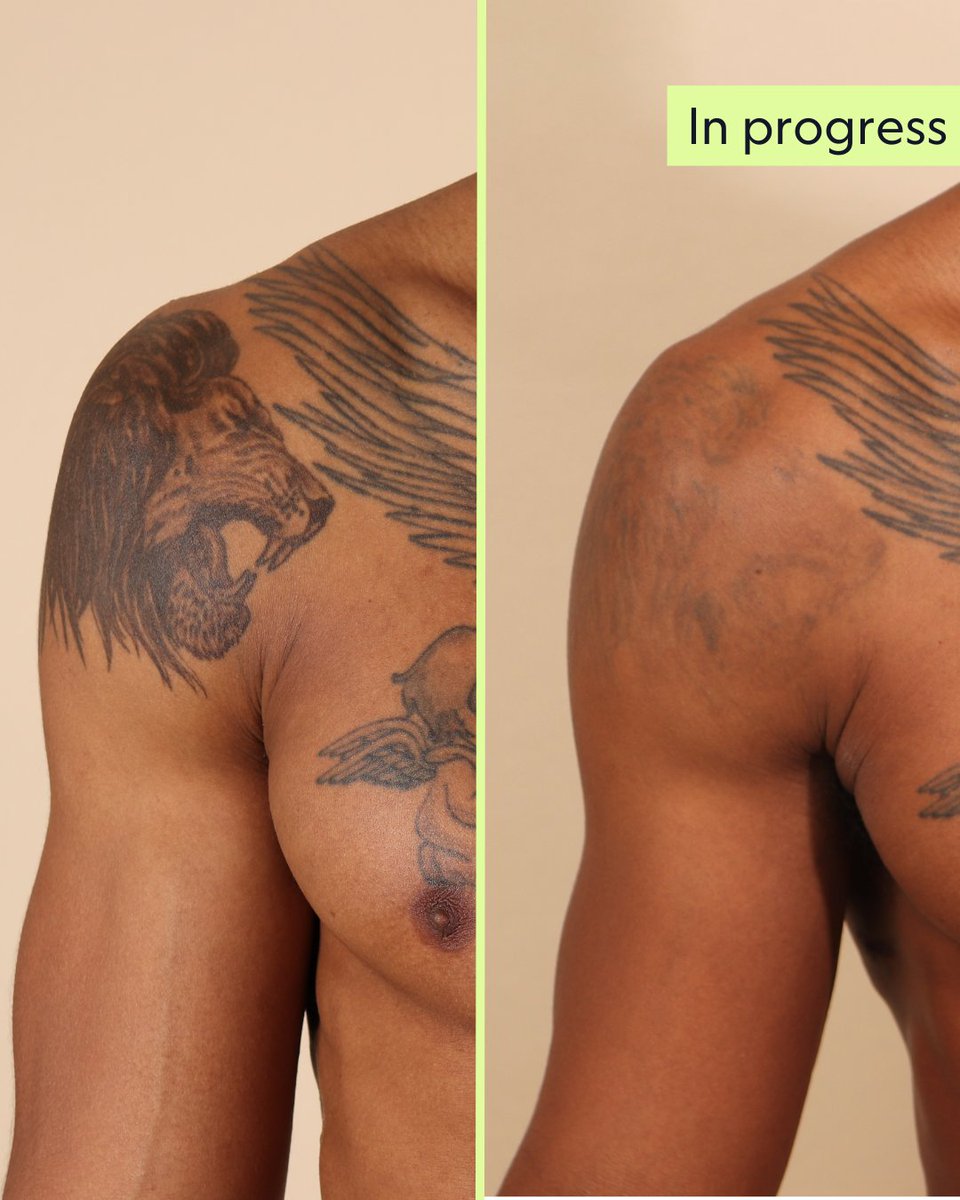 💬 'I can't thank you guys enough.'

Swipe to see Bilal's progress 👉️ What a difference so far! It won't be long before these old lion tattoos are gone for good. 

#tattooremoval #tattoos #tattoolondon #tattooremovalresults