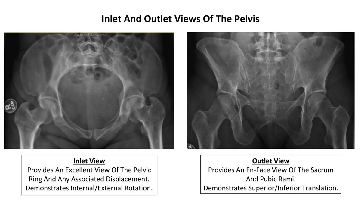 Dive into our latest Adult Ortho Cases series focusing on Pelvic Ring injuries. litfl.com/adult-ortho-ca… #MedEd #MedTwitter #FOAMed #Radiology