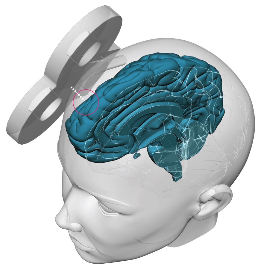 Martijn Arns (@brainclinics) on Twitter photo De Brainclinics TMS Masterclass is nu officieel geaccrediteerd door NVvP, FGzPt en de <a href="/Hersenstim/">Stichting Hersenstimulatie</a> en er zijn nog een handjevol plekken beschikbaar.
Schrijf je daarom nu in en leer alles over TMS, SAINT, tFUS en tES van de internationale experts!
Registreer hier: De Brainclinics TMS Masterclass is nu officieel geaccrediteerd door NVvP, FGzPt en de <a href="/Hersenstim/">Stichting Hersenstimulatie</a> en er zijn nog een handjevol plekken beschikbaar.
Schrijf je daarom nu in en leer alles over TMS, SAINT, tFUS en tES van de internationale experts!
Registreer hier: