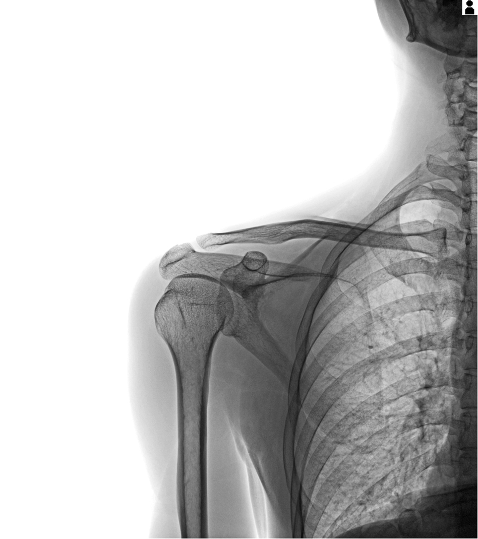 A postoperative increase in PASS score of ≥16.5 points had a 90% chance of being a true-positive change, while a score change of approximately 13 points was likely clinically relevant #OrthoTwitter See the results #OpenAccess here! ow.ly/900650QNNVq