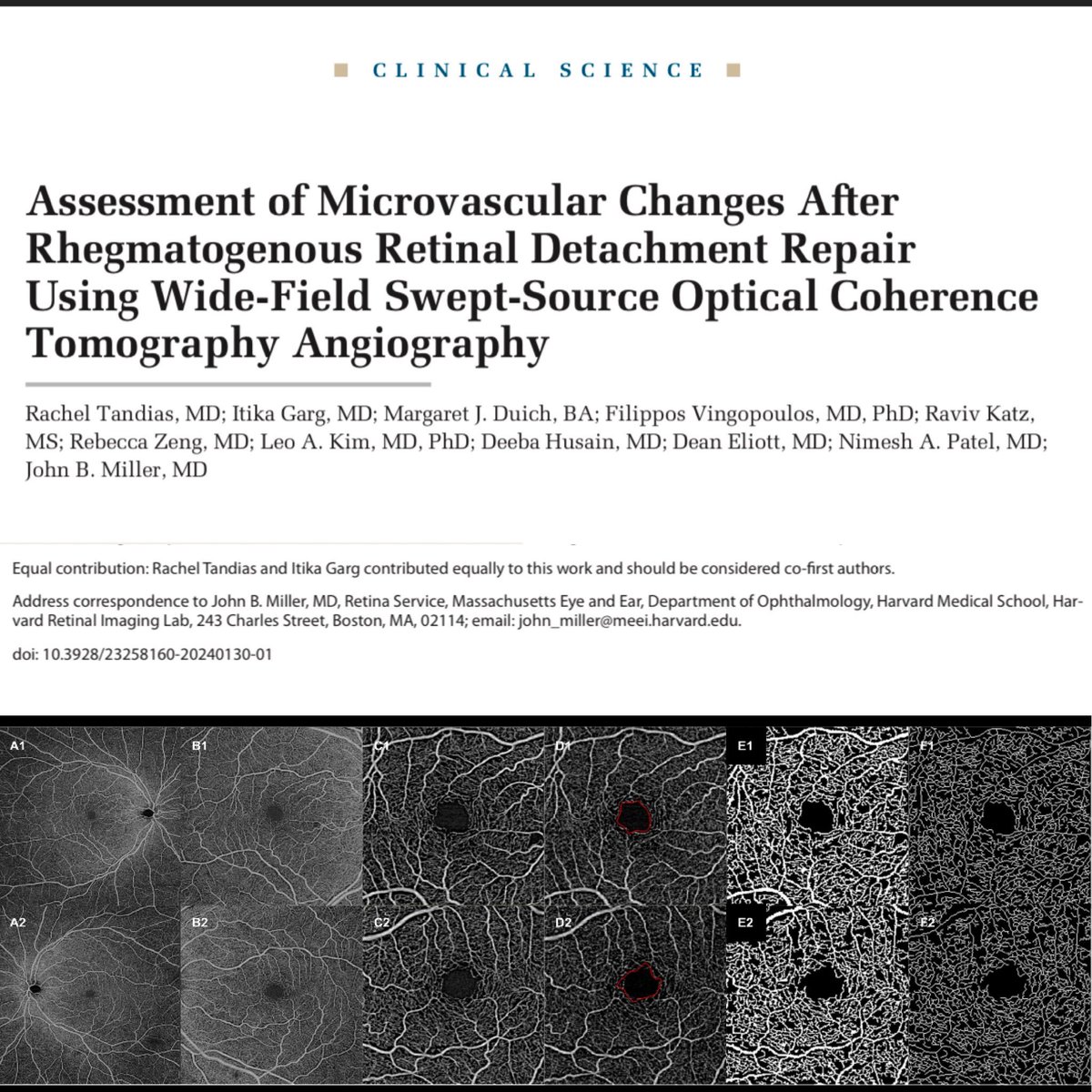 Itika Garg, MD (@itikagarg) on Twitter photo Check out our paper assessing association between #OCTA vascular metrics and visual acuity in eyes with Rhegmatogenous #RetinalDetachment repair👇 #HarvardRetinalImagingLab <a href="/HMSeye/">Harvard Ophthalmology</a> <a href="/JohnBMillerMD/">John B. Miller</a> #OSLIRetina
journals.healio.com/doi/10.3928/23… Check out our paper assessing association between #OCTA vascular metrics and visual acuity in eyes with Rhegmatogenous #RetinalDetachment repair👇 #HarvardRetinalImagingLab <a href="/HMSeye/">Harvard Ophthalmology</a> <a href="/JohnBMillerMD/">John B. Miller</a> #OSLIRetina
journals.healio.com/doi/10.3928/23…