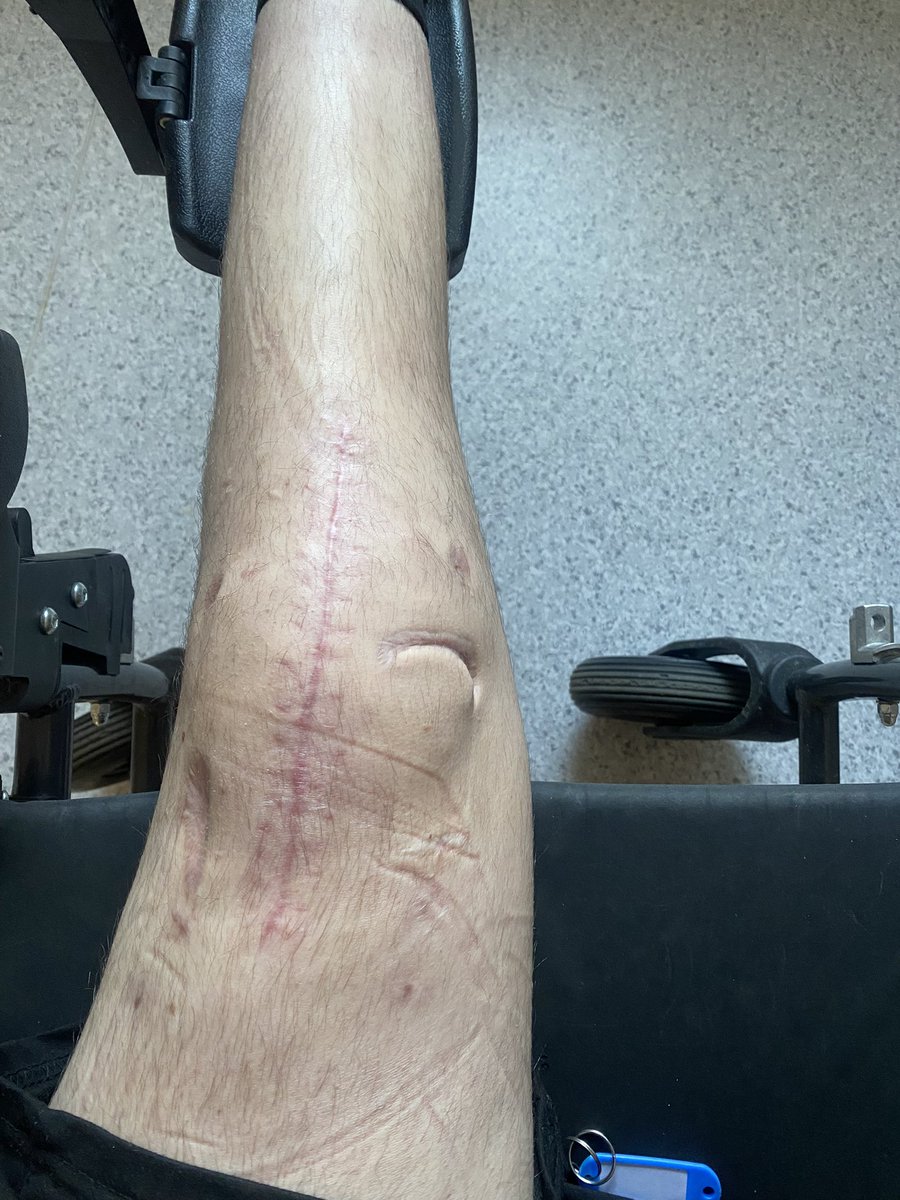 bogdan_kovbasuk's tweet photo. Збір на титанове коліно

Я Ковбасюк Богдан з перших днів війни вступив до лав ЗСУ та захищав Україну на Харківському напрямку, отримав осколкове поранення обох ніг, та праву нажаль довелось ампутувати! 

Реквізити:
https://t.co/dTPNjiho2p

💳Номер картки
5375 4112 1669 3569 https://t.co/9zN1H6z7mi
