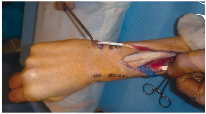 Tendon transfers are a crucial surgical intervention in the management of cerebral palsy (CP). They involve the re-routing of tendons to improve muscle balance, function, and overall mobility in individuals with CP. Let's delve into the intricacies, Art🎨 or Science🧪🥼.