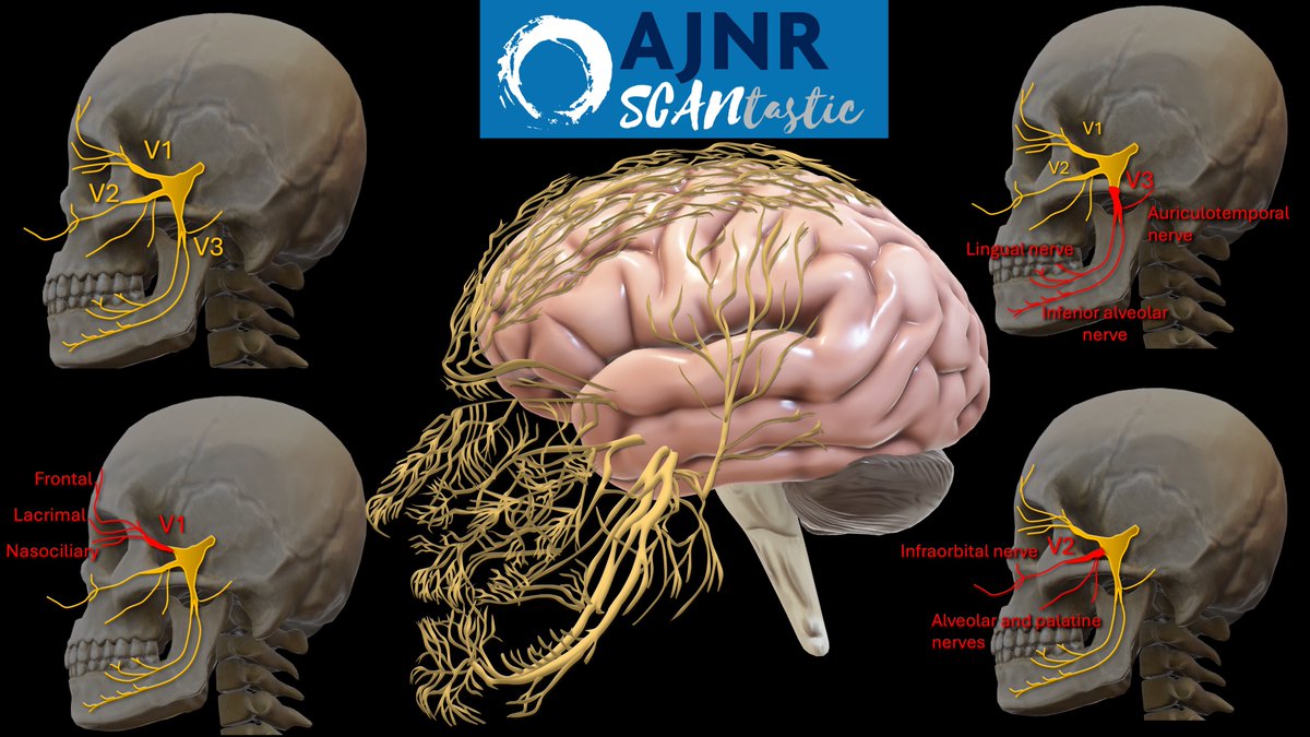 1/Does trying to diagnose trigeminal neuralgia give you a splitting headache?

Luckily, the answer is written all over your face!

This week's @theAJNR SCANtastic is in your face--showing you how you can visualize trigeminal injury on MR neurography!

ajnr.org/content/45/3/3…