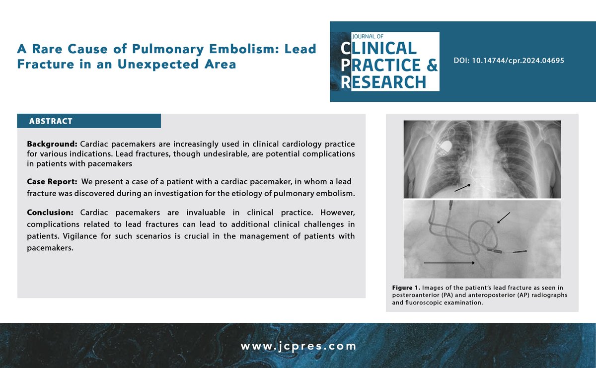 A Rare Cause of Pulmonary Embolism: Lead Fracture in an Unexpected Area

jcpres.com/storage/upload…

#pulmonary #Arrhythmias #echocardiography #FOAMed #FOAM #MedTwitter #MedEducation #medicaljournal #JClinPractRes