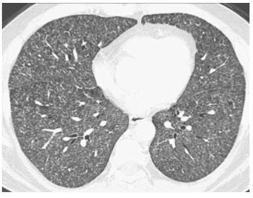 You are reading this chest CT: how would you report these findings?

🚨After the previous 1984,1996 and 2008 editions, an updated Fleischner Society GLOSSARY OF TERMS FOR THORACIC IMAGING was just published in <a href="/radiology_rsna/">Radiology</a>
doi.org/10.1148/radiol…

A #RadInTraining #Tweetorial