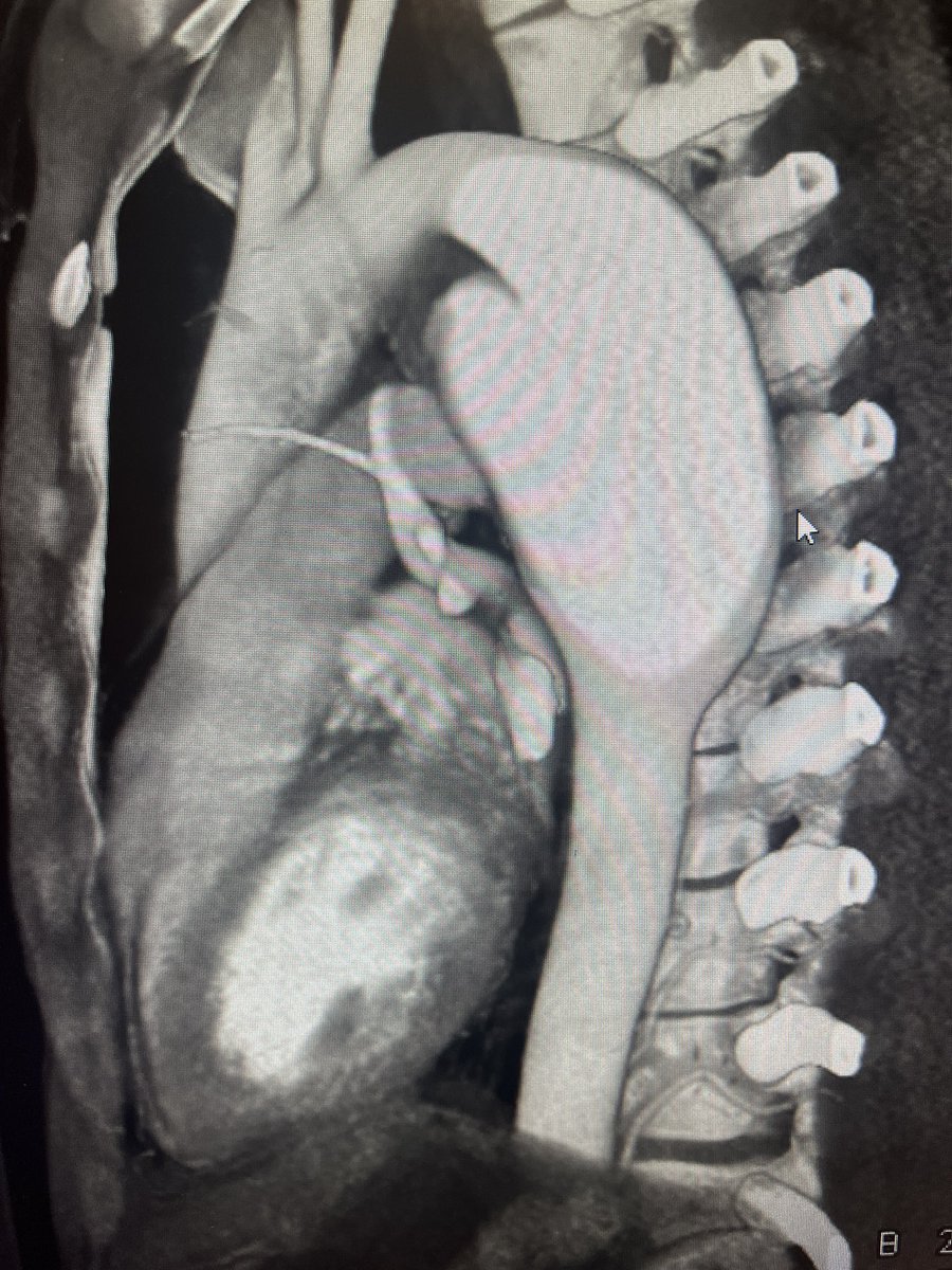 Hump day @JHHVascular . MFS. 5.5 cm DTAA. Also 4.8 root . Which goes first ? #aortaEd