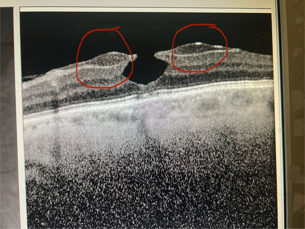 Lamella hole associate epiretinal proliferation. Classical appearance