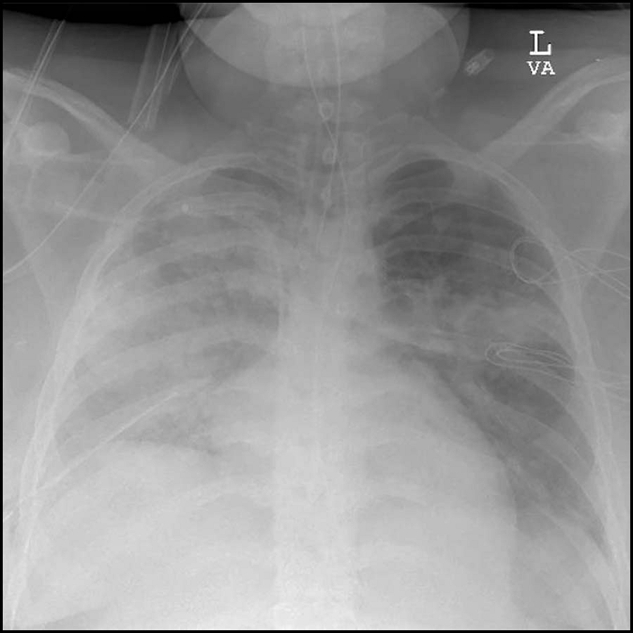 A preliminary study published in @_Anethesiology suggests that diaphragm neurostimulation could positively affect lung mechanics and hemodynamics in patients with ARDS. Read more: ow.ly/nJp150QZHB6 #anesthesiologist #anesthesiology