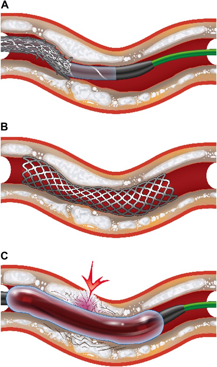 MyJSCAI's tweet photo. 🆕💥Vascular calcification is a hallmark of atherosclerosis, posing challenges for #PCI. Authors highlight coronary #CT's vital role in assessing &amp; quantifying vascular calcification for optimal PCI planning.

➡️https://t.co/ThXFzl3mbg

@ColletCarlos @bouissetfred https://t.co/215QIjL9Yg