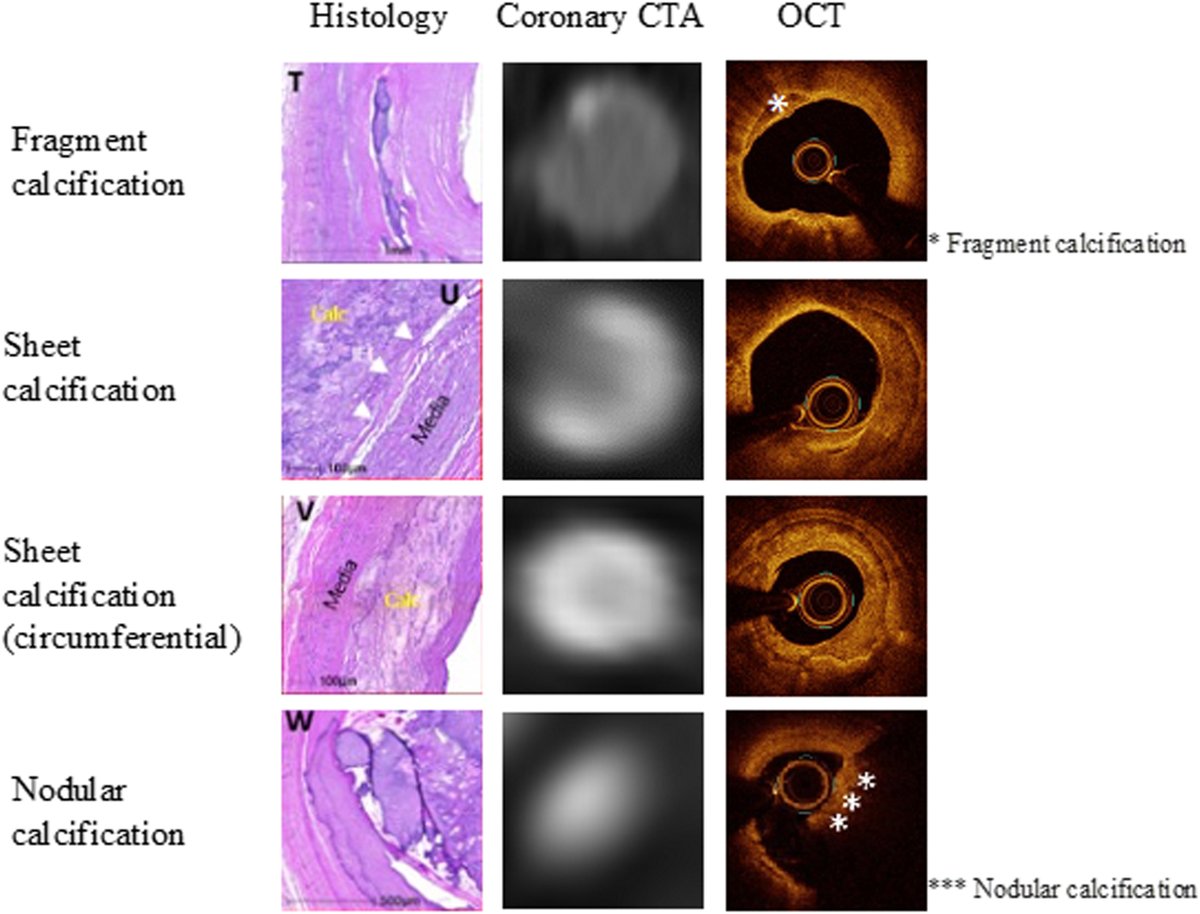 🆕💥Vascular calcification is a hallmark of atherosclerosis, posing challenges for #PCI. Authors highlight coronary #CT's vital role in assessing & quantifying vascular calcification for optimal PCI planning. ➡️doi.org/10.1016/j.jsca… @ColletCarlos @bouissetfred