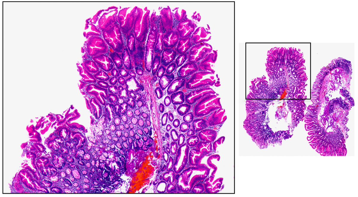ArdalanFarid's tweet photo. A polyp in the left colon, diagnosis?
#GIpath
#PathTwitter
#Polyp
#Colon https://t.co/5gPnINbj81