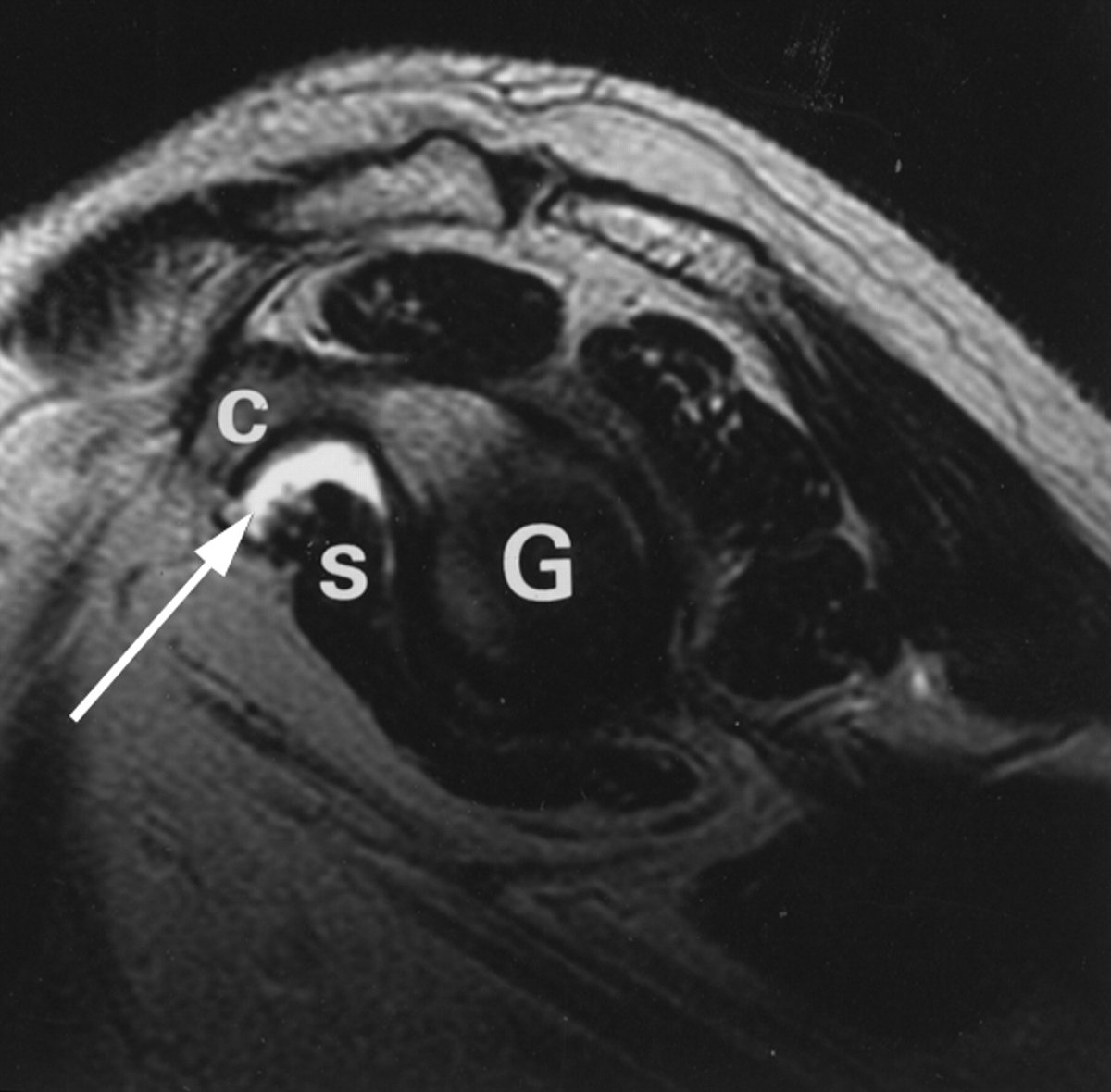 Rheumatology's tweet photo. If we see a subcoracoid bursa, we must differentiate sonographically or exceptionally on MRI between a real isolated subcoracoid bursa, a subcoracoid extension of the subdeltoid bursa, a coracobrachial bursa and a subcoracoid extension of the recess under the subscapularis (anatomically correct, this does not actually correspond to a bursa, as up to 98% of it communicates with the joint).

https://t.co/msQ3frOdET

https://t.co/rfC7tIsV4z