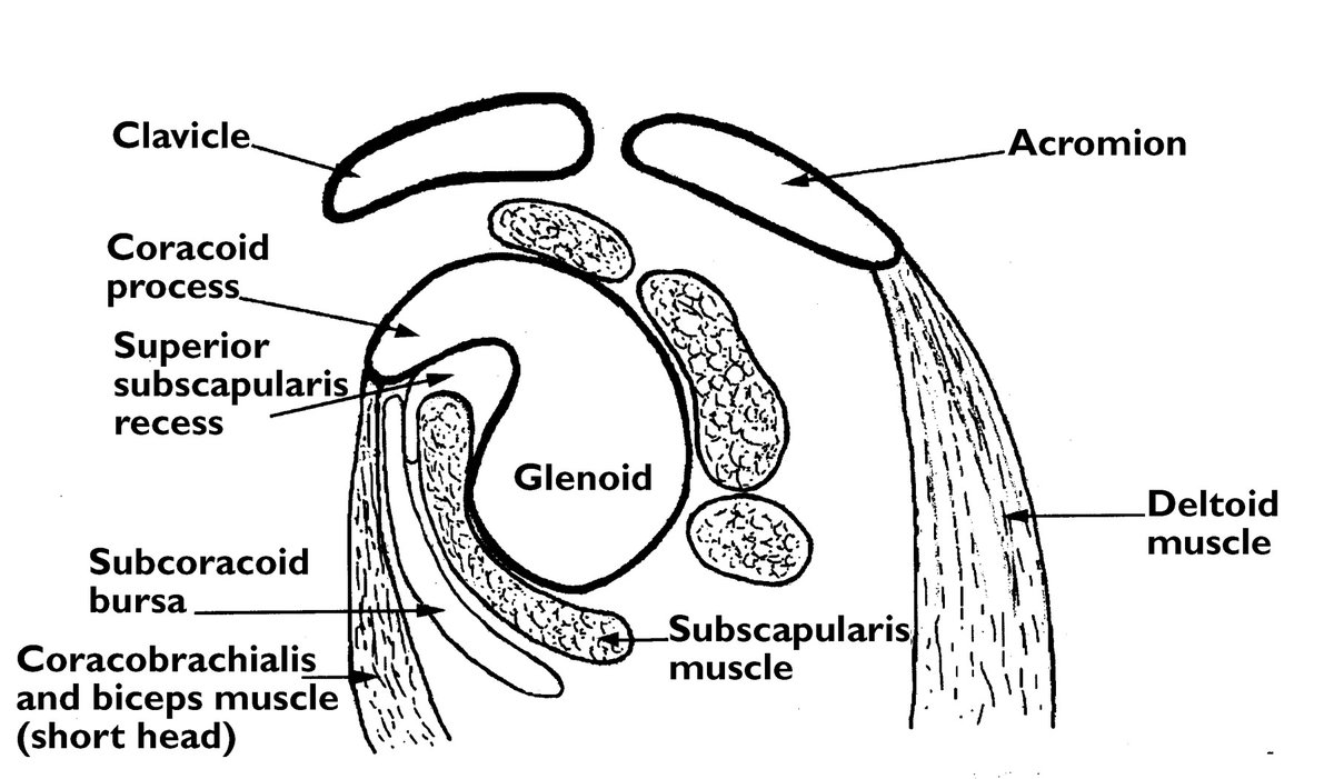 Rheumatology's tweet photo. If we see a subcoracoid bursa, we must differentiate sonographically or exceptionally on MRI between a real isolated subcoracoid bursa, a subcoracoid extension of the subdeltoid bursa, a coracobrachial bursa and a subcoracoid extension of the recess under the subscapularis (anatomically correct, this does not actually correspond to a bursa, as up to 98% of it communicates with the joint).

https://t.co/msQ3frOdET

https://t.co/rfC7tIsV4z