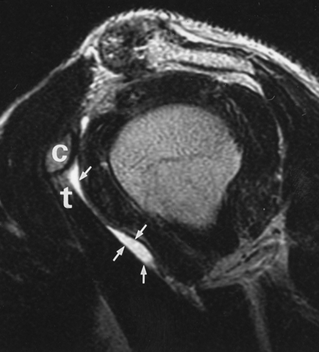 Rheumatology's tweet photo. If we see a subcoracoid bursa, we must differentiate sonographically or exceptionally on MRI between a real isolated subcoracoid bursa, a subcoracoid extension of the subdeltoid bursa, a coracobrachial bursa and a subcoracoid extension of the recess under the subscapularis (anatomically correct, this does not actually correspond to a bursa, as up to 98% of it communicates with the joint).

https://t.co/msQ3frOdET

https://t.co/rfC7tIsV4z